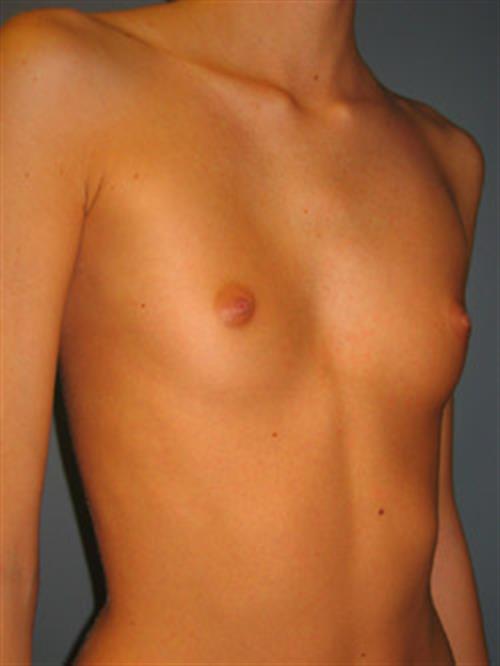 Breast Augmentation Before Photo | Phoenix and Scottsdale, AZ | Scottsdale Center for Plastic Surgery