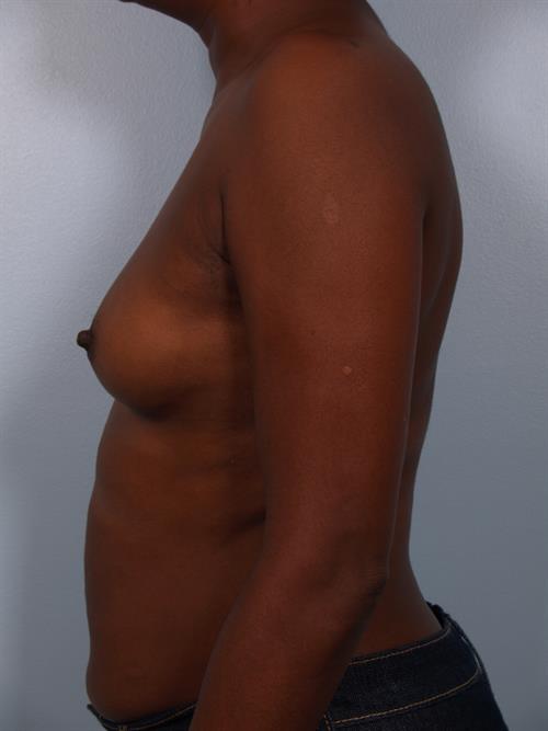 Breast Augmentation Before Photo | Phoenix and Scottsdale, AZ | Scottsdale Center for Plastic Surgery