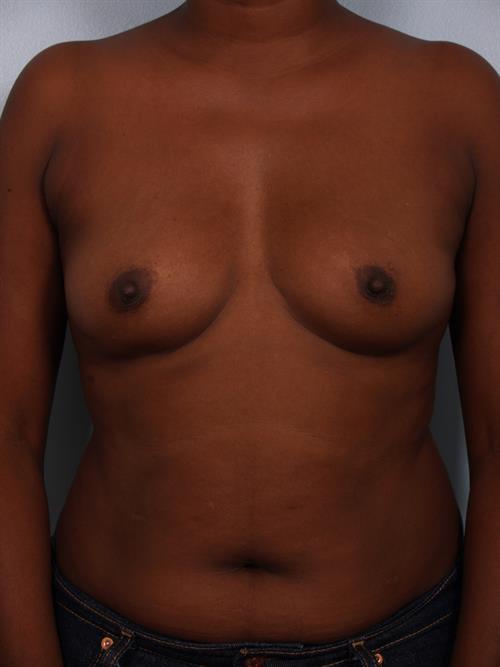 Breast Augmentation Before Photo | Phoenix and Scottsdale, AZ | Scottsdale Center for Plastic Surgery
