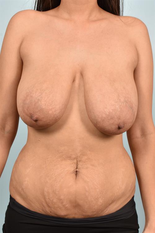Breast Reduction Before Photo | Phoenix and Scottsdale, AZ | Scottsdale Center for Plastic Surgery