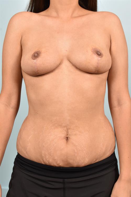 Breast Reduction After Photo | Phoenix and Scottsdale, AZ | Scottsdale Center for Plastic Surgery