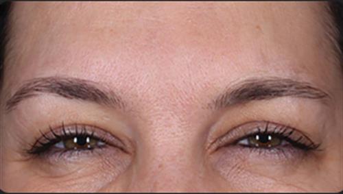 DAXXIFY After Photo | Phoenix and Scottsdale, AZ | Scottsdale Center for Plastic Surgery