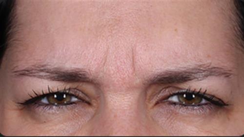 DAXXIFY Before Photo | Phoenix and Scottsdale, AZ | Scottsdale Center for Plastic Surgery