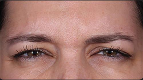 DAXXIFY After Photo | Phoenix and Scottsdale, AZ | Scottsdale Center for Plastic Surgery