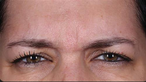 DAXXIFY After Photo | Phoenix and Scottsdale, AZ | Scottsdale Center for Plastic Surgery