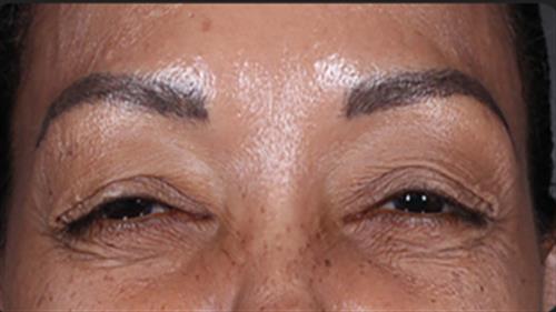 DAXXIFY After Photo | Phoenix and Scottsdale, AZ | Scottsdale Center for Plastic Surgery