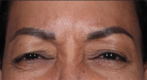 DAXXIFY After Photo | Phoenix and Scottsdale, AZ | Scottsdale Center for Plastic Surgery