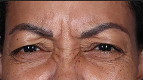 DAXXIFY Before Photo | Phoenix and Scottsdale, AZ | Scottsdale Center for Plastic Surgery