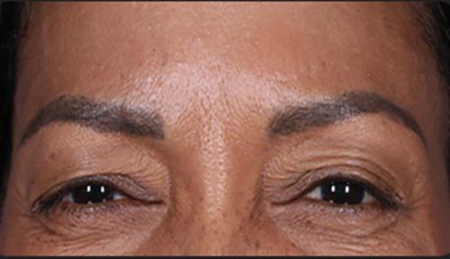 DAXXIFY After Photo | Phoenix and Scottsdale, AZ | Scottsdale Center for Plastic Surgery