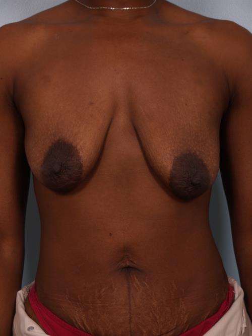 Breast Lift (Mastopexy) Before Photo | Phoenix and Scottsdale, AZ | Scottsdale Center for Plastic Surgery