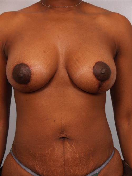 Breast Lift (Mastopexy) After Photo | Phoenix and Scottsdale, AZ | Scottsdale Center for Plastic Surgery