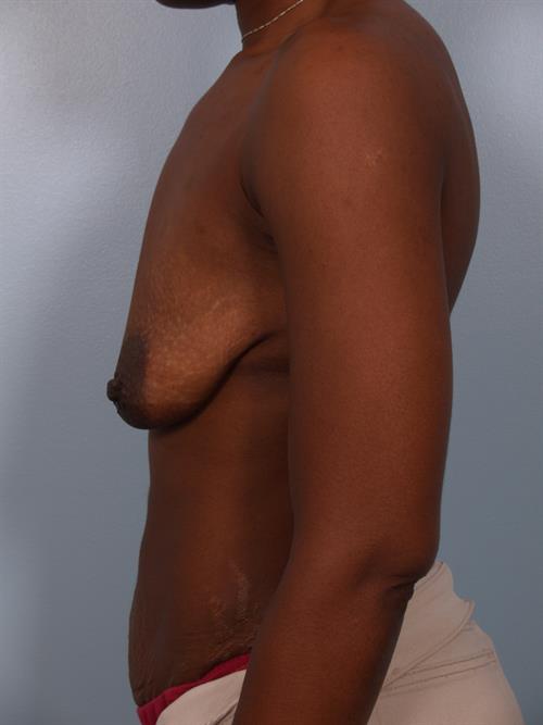 Breast Lift (Mastopexy) Before Photo | Phoenix and Scottsdale, AZ | Scottsdale Center for Plastic Surgery