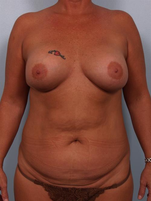 Revision Breast Surgery Before Photo | Phoenix and Scottsdale, AZ | Scottsdale Center for Plastic Surgery