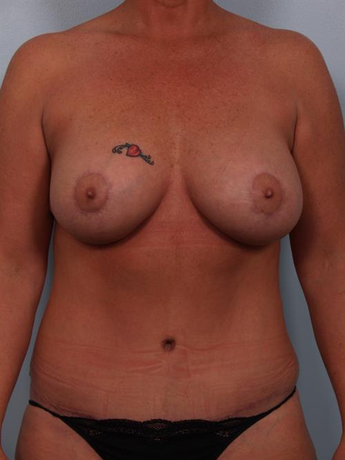 Revision Breast Surgery After Photo | Phoenix and Scottsdale, AZ | Scottsdale Center for Plastic Surgery
