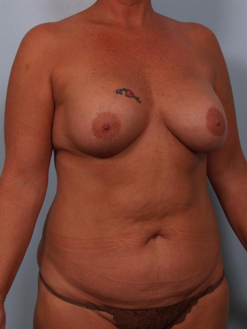 Revision Breast Surgery Before Photo | Phoenix and Scottsdale, AZ | Scottsdale Center for Plastic Surgery