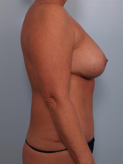 Revision Breast Surgery After Photo | Phoenix and Scottsdale, AZ | Scottsdale Center for Plastic Surgery