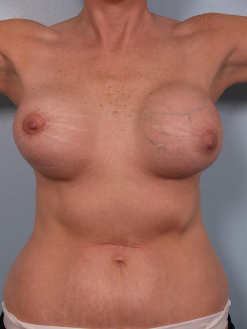 Revision Breast Surgery Before Photo | Phoenix and Scottsdale, AZ | Scottsdale Center for Plastic Surgery