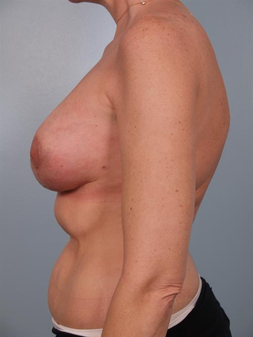 Revision Breast Surgery After Photo | Phoenix and Scottsdale, AZ | Scottsdale Center for Plastic Surgery