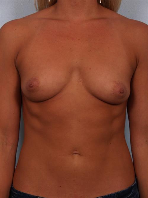 Breast Augmentation Before Photo | Phoenix and Scottsdale, AZ | Scottsdale Center for Plastic Surgery