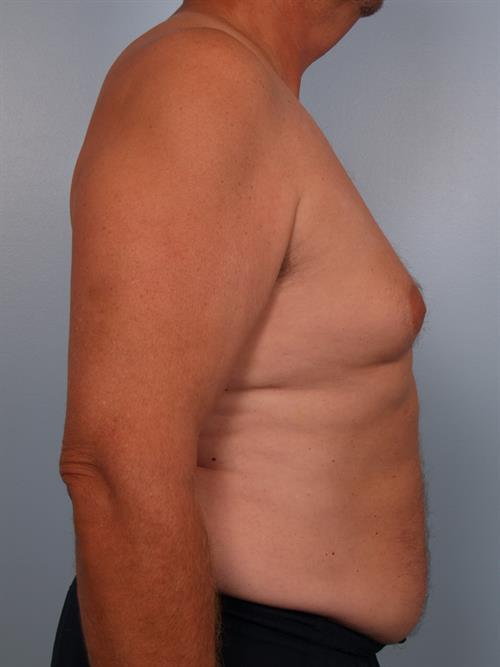 Male Breast/Areola Reduction Before Photo | Phoenix and Scottsdale, AZ | Scottsdale Center for Plastic Surgery