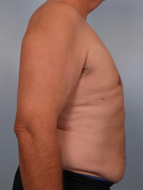 Male Breast/Areola Reduction After Photo | Phoenix and Scottsdale, AZ | Scottsdale Center for Plastic Surgery