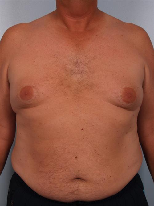 Male Breast/Areola Reduction Before Photo | Phoenix and Scottsdale, AZ | Scottsdale Center for Plastic Surgery