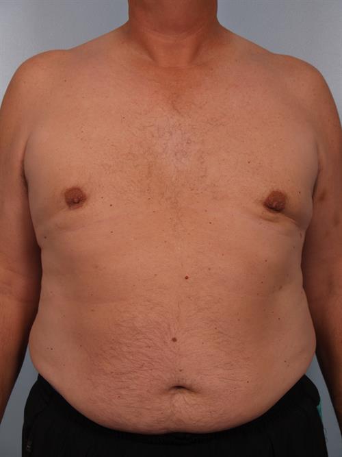 Male Breast/Areola Reduction After Photo | Phoenix and Scottsdale, AZ | Scottsdale Center for Plastic Surgery