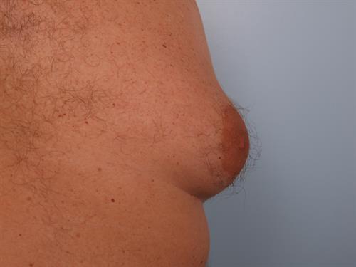 Male Breast/Areola Reduction Before Photo | Phoenix and Scottsdale, AZ | Scottsdale Center for Plastic Surgery