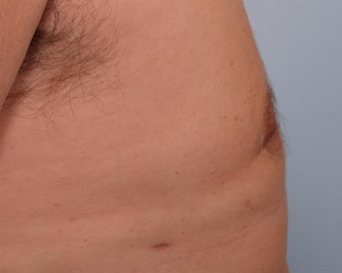 Male Breast/Areola Reduction After Photo | Phoenix and Scottsdale, AZ | Scottsdale Center for Plastic Surgery