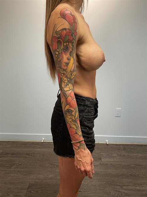 Sub-Fascial Breast Revision Before Photo | Phoenix and Scottsdale, AZ | Scottsdale Center for Plastic Surgery