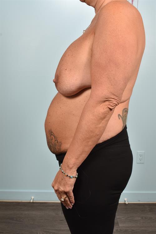 Tummy Tuck Before Photo | Phoenix and Scottsdale, AZ | Scottsdale Center for Plastic Surgery