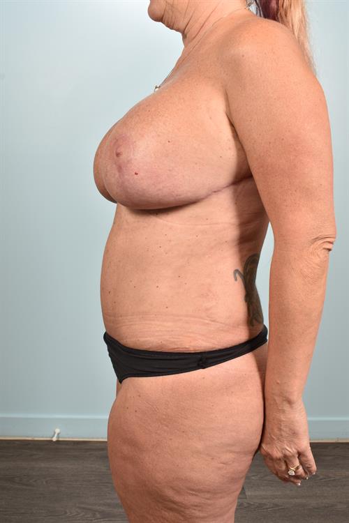 Tummy Tuck After Photo | Phoenix and Scottsdale, AZ | Scottsdale Center for Plastic Surgery