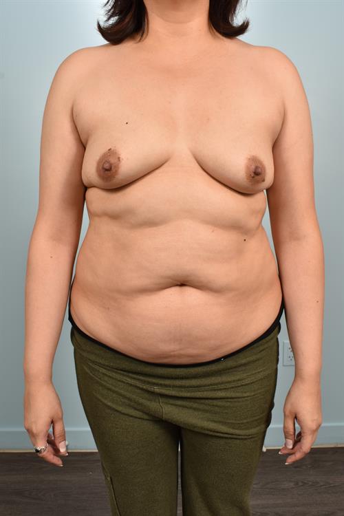 Sub-Fascial Breast Augmentation Before Photo | Phoenix and Scottsdale, AZ | Scottsdale Center for Plastic Surgery