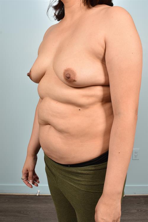 Sub-Fascial Breast Augmentation Before Photo | Phoenix and Scottsdale, AZ | Scottsdale Center for Plastic Surgery