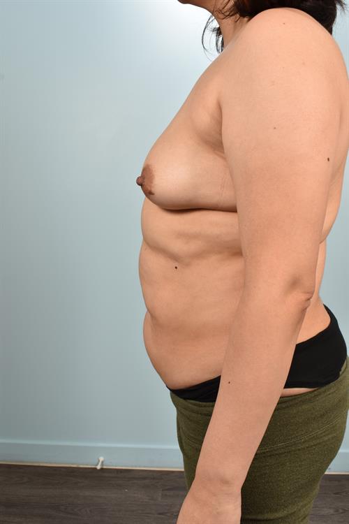 Sub-Fascial Breast Augmentation Before Photo | Phoenix and Scottsdale, AZ | Scottsdale Center for Plastic Surgery