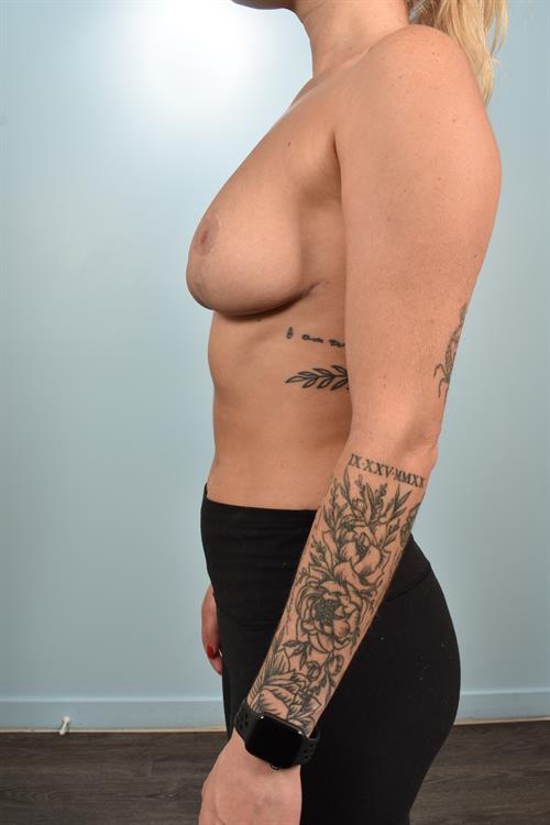 Breast Reduction After Photo | Phoenix and Scottsdale, AZ | Scottsdale Center for Plastic Surgery