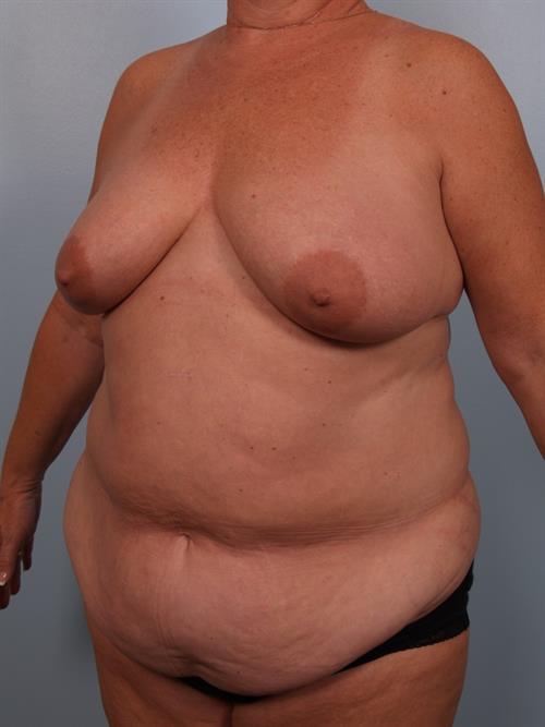Tummy Tuck Before Photo | Phoenix and Scottsdale, AZ | Scottsdale Center for Plastic Surgery