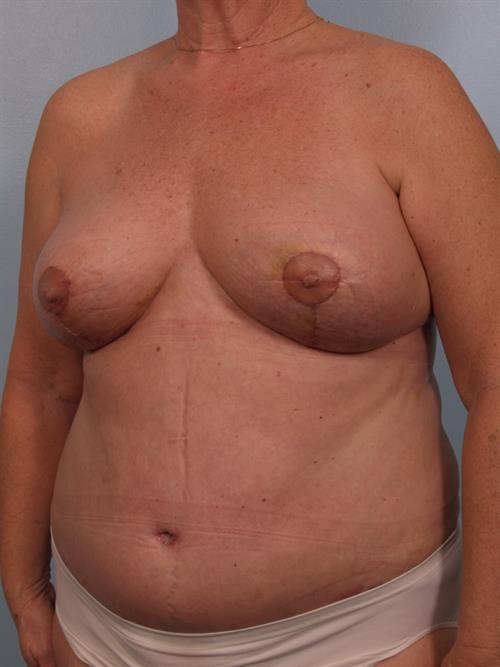 Tummy Tuck After Photo | Phoenix and Scottsdale, AZ | Scottsdale Center for Plastic Surgery