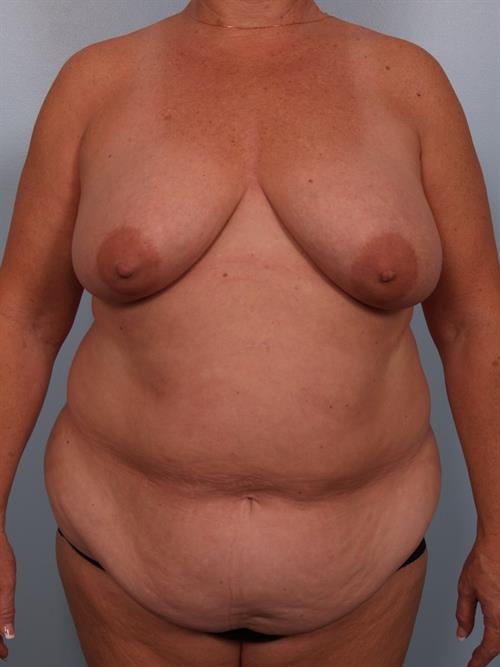 Tummy Tuck Before Photo | Phoenix and Scottsdale, AZ | Scottsdale Center for Plastic Surgery