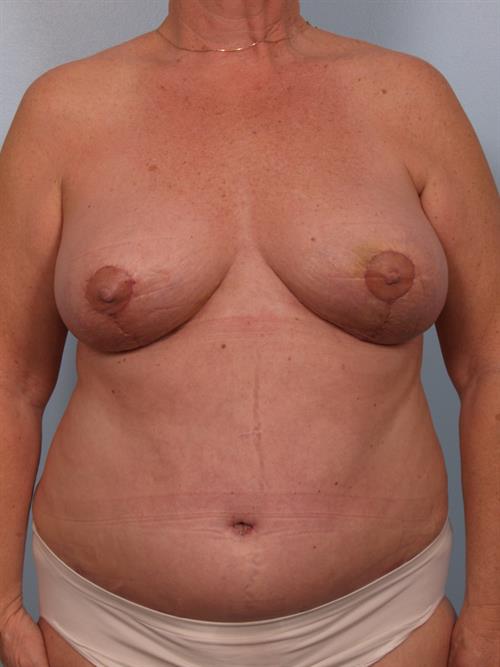 Tummy Tuck After Photo | Phoenix and Scottsdale, AZ | Scottsdale Center for Plastic Surgery