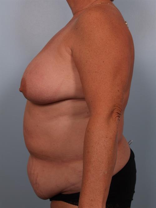 Tummy Tuck Before Photo | Phoenix and Scottsdale, AZ | Scottsdale Center for Plastic Surgery