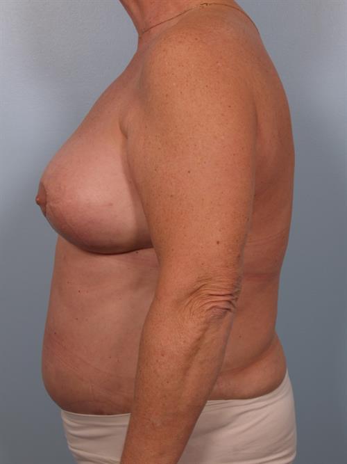 Tummy Tuck After Photo | Phoenix and Scottsdale, AZ | Scottsdale Center for Plastic Surgery