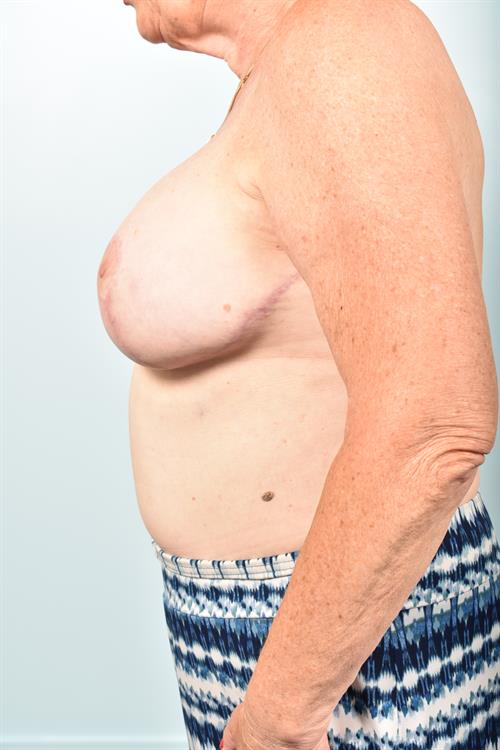 Sub-Fascial Breast Revision After Photo | Phoenix and Scottsdale, AZ | Scottsdale Center for Plastic Surgery