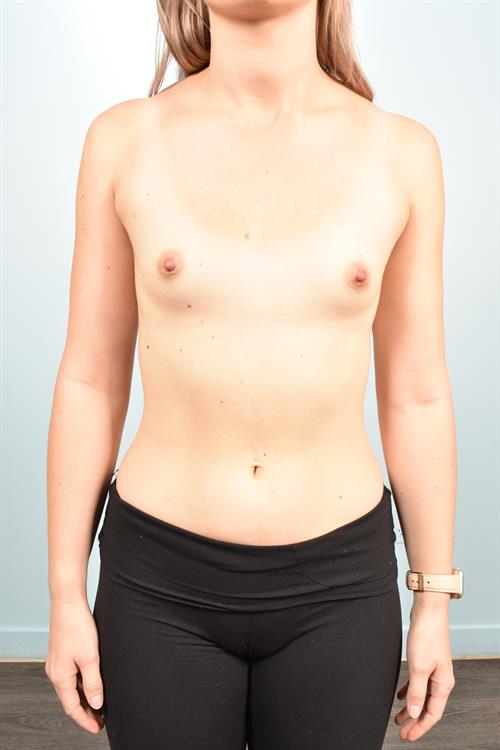 Sub-Fascial Breast Augmentation Before Photo | Phoenix and Scottsdale, AZ | Scottsdale Center for Plastic Surgery