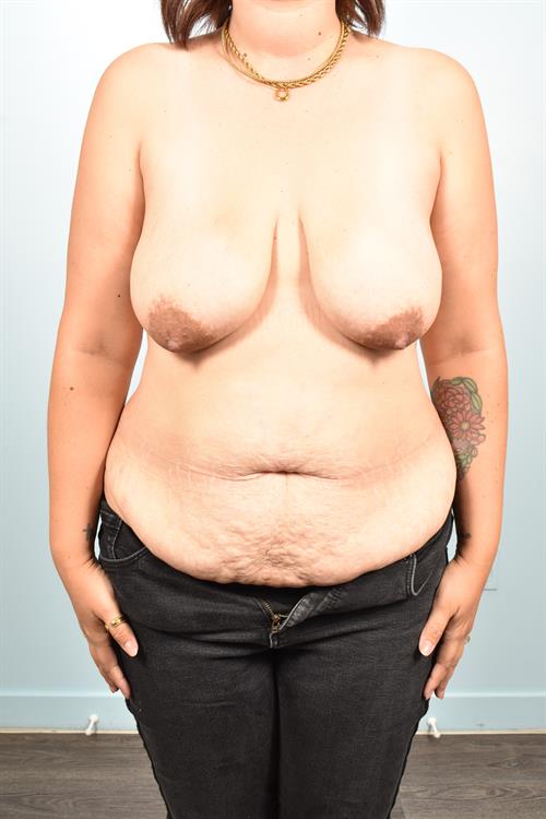Sub-Fascial Breast Augmentation Before Photo | Phoenix and Scottsdale, AZ | Scottsdale Center for Plastic Surgery
