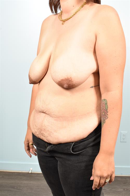 Tummy Tuck Before Photo | Phoenix and Scottsdale, AZ | Scottsdale Center for Plastic Surgery