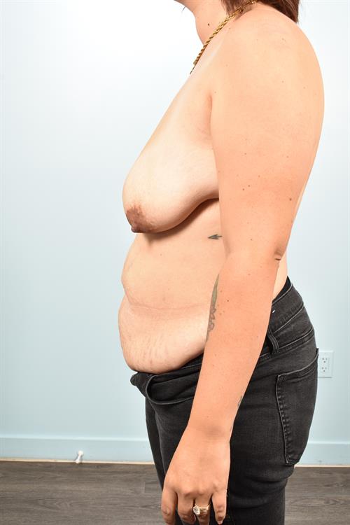 Tummy Tuck Before Photo | Phoenix and Scottsdale, AZ | Scottsdale Center for Plastic Surgery