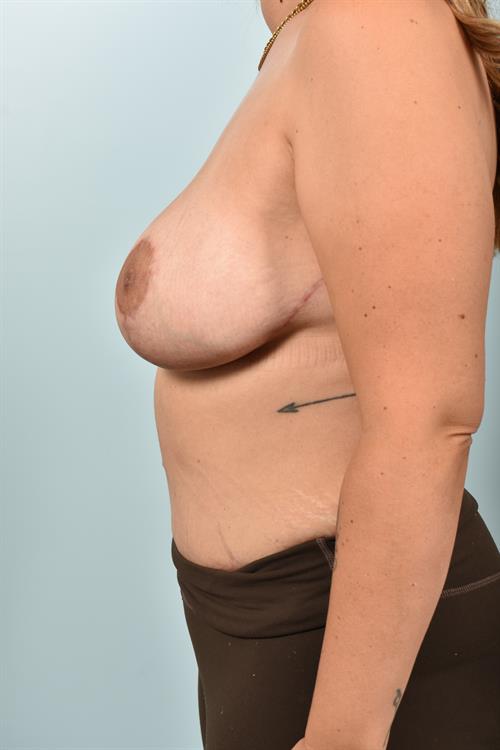 Tummy Tuck After Photo | Phoenix and Scottsdale, AZ | Scottsdale Center for Plastic Surgery