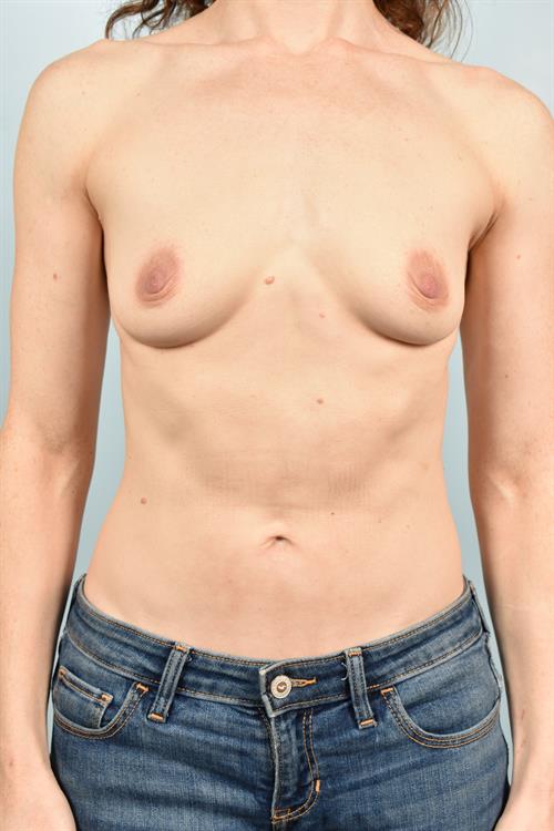 Sub-Fascial Breast Augmentation Before Photo | Phoenix and Scottsdale, AZ | Scottsdale Center for Plastic Surgery