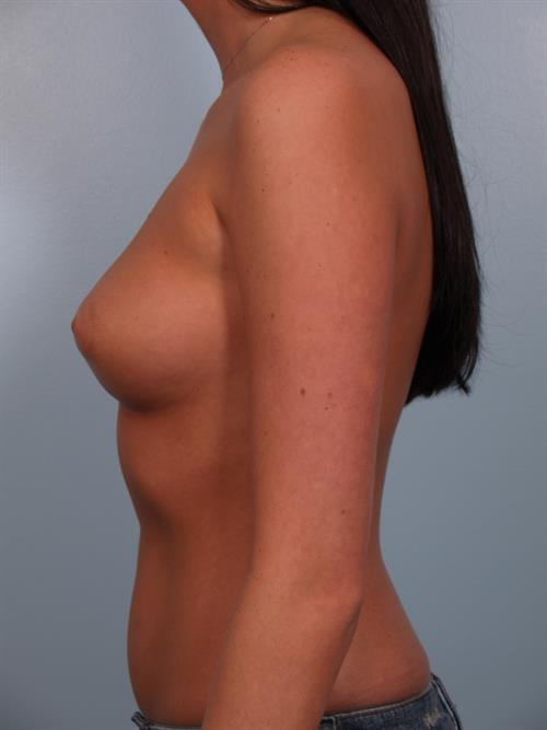 Breast Augmentation Before Photo | Phoenix and Scottsdale, AZ | Scottsdale Center for Plastic Surgery